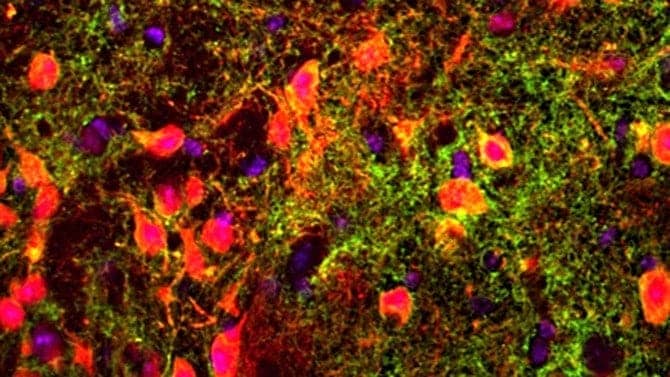El gen involucrado en el sentido del olfato podría desempeñar un papel en la propagación del cáncer de mama al cerebro.