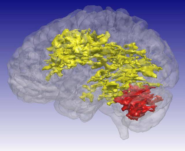 Las exploraciones muestran conexiones debilitadas en los cerebros de los adolescentes en riesgo de trastorno bipolar