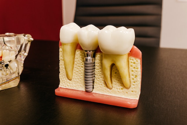 5 consejos para seleccionar un centro de implantes dentales