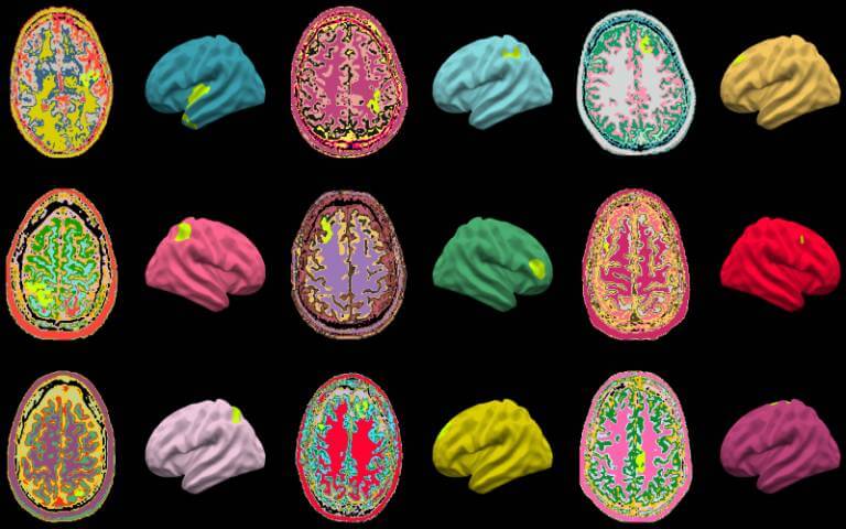¿Cuántos años tiene tu cerebro, en realidad?  La IA refleja con precisión el riesgo de deterioro cognitivo y Alzheimer según la edad del cerebro